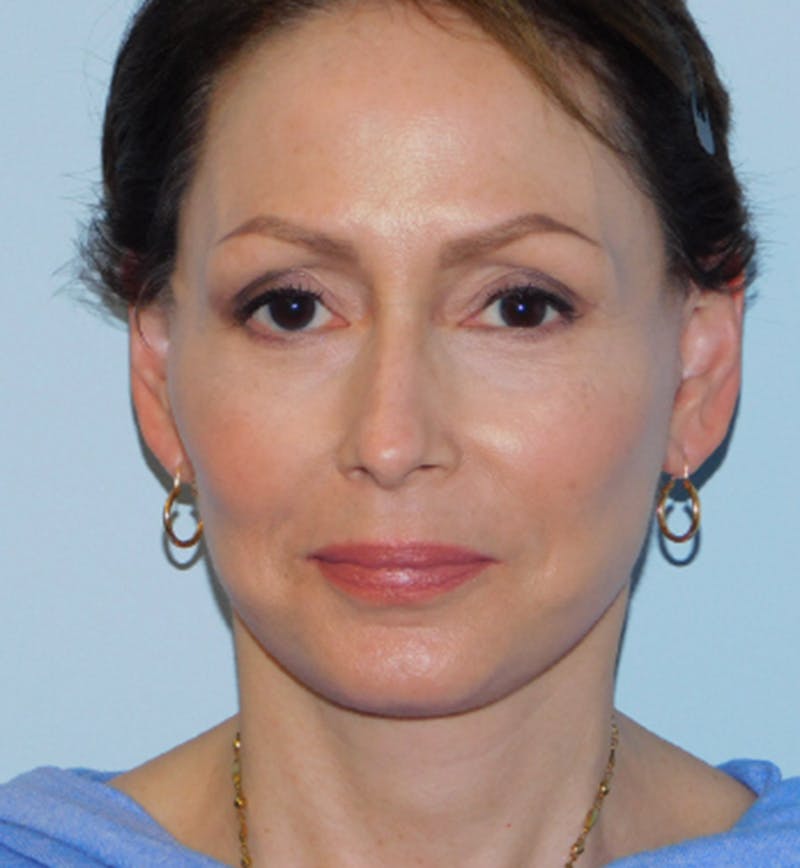 Mini-Facelift Before & After Gallery - Patient 133066223 - Image 2