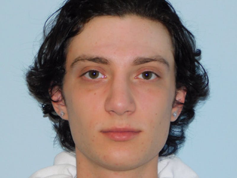 Rhinoplasty Before & After Gallery - Patient 133066222 - Image 8