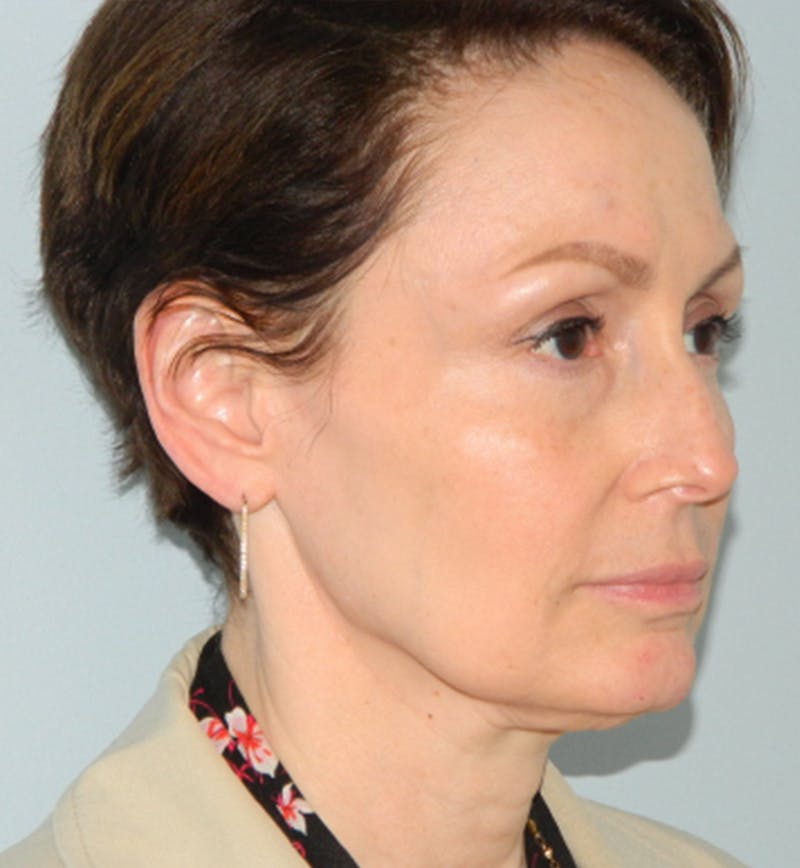Mini-Facelift Before & After Gallery - Patient 133066223 - Image 3