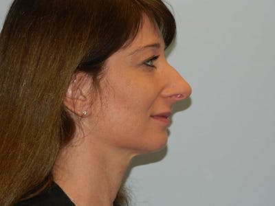 Rhinoplasty Before & After Gallery - Patient 133066224 - Image 1