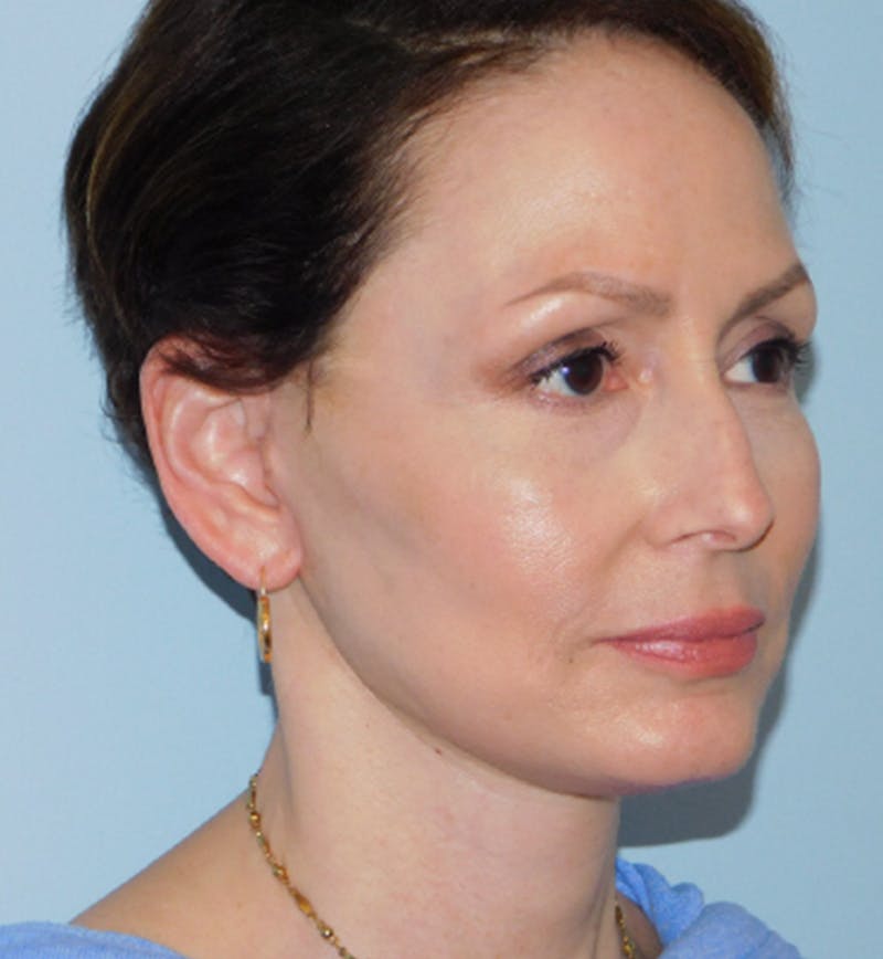 Mini-Facelift Before & After Gallery - Patient 133066223 - Image 4