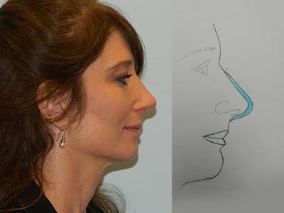 Rhinoplasty Before & After Gallery - Patient 133066224 - Image 2