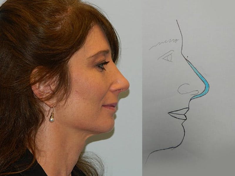 Rhinoplasty Before & After Gallery - Patient 133066224 - Image 2