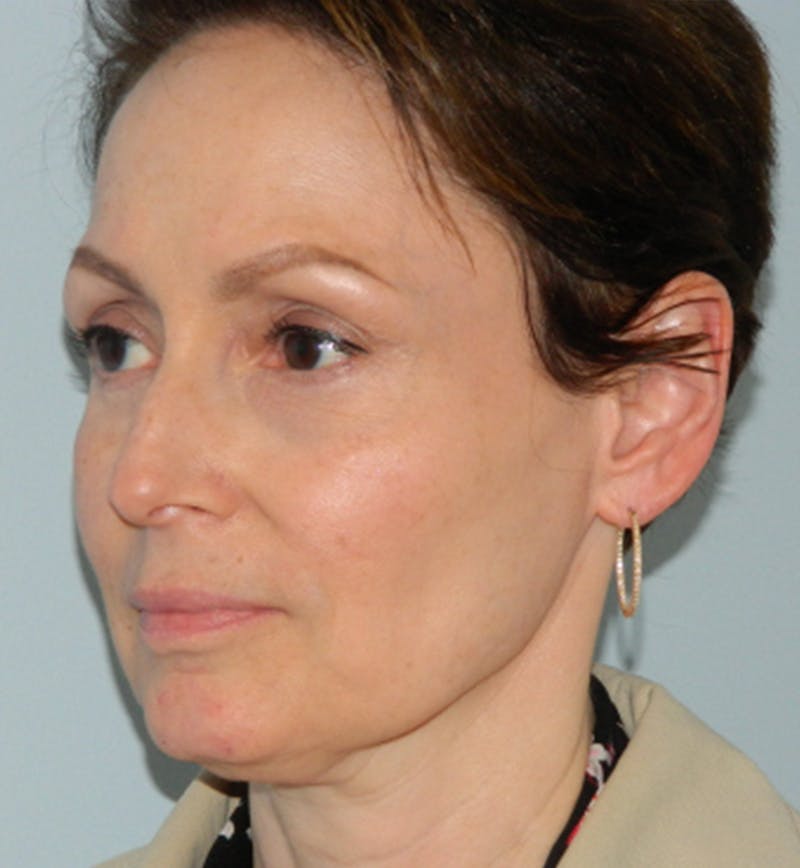 Mini-Facelift Before & After Gallery - Patient 133066223 - Image 5