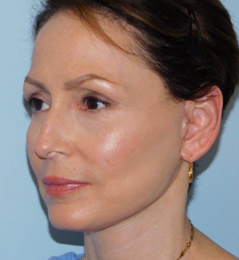 Mini-Facelift Before & After Gallery - Patient 133066223 - Image 6