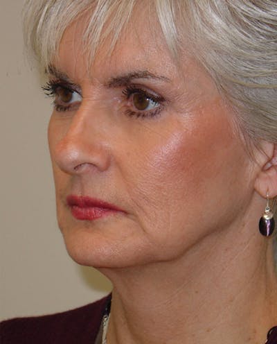 Mini-Facelift Before & After Gallery - Patient 133066225 - Image 1