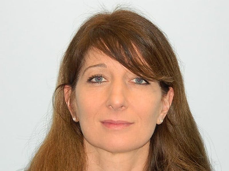 Rhinoplasty Before & After Gallery - Patient 133066224 - Image 7