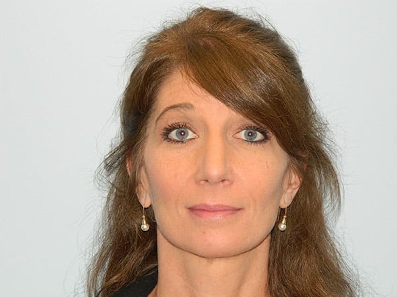 Rhinoplasty Before & After Gallery - Patient 133066224 - Image 8