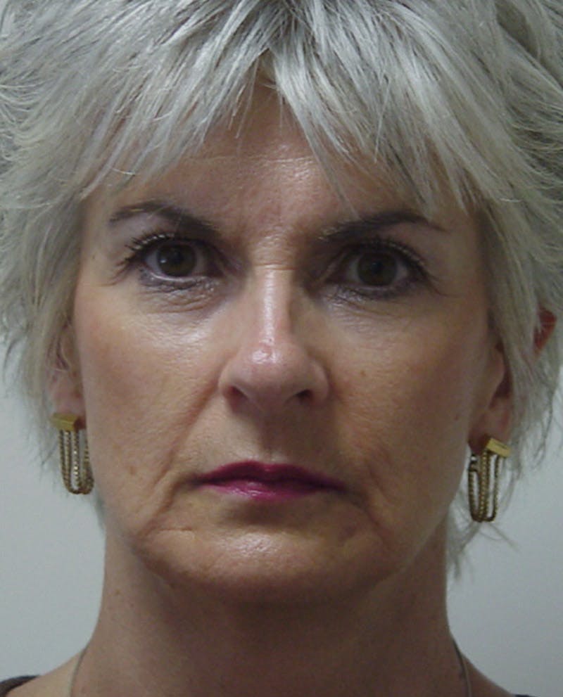 Mini-Facelift Before & After Gallery - Patient 133066225 - Image 3