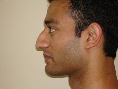Rhinoplasty Before & After Gallery - Patient 133066228 - Image 1