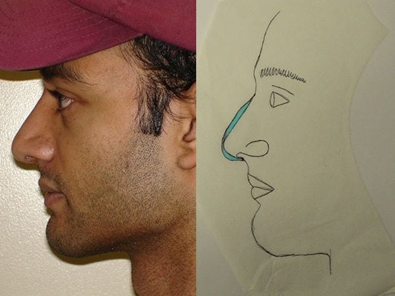 Rhinoplasty Before & After Gallery - Patient 133066228 - Image 2