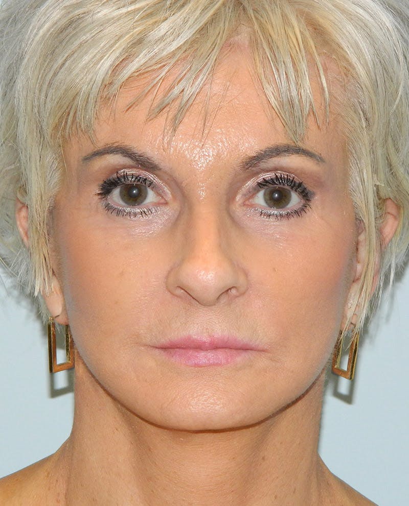 Mini-Facelift Before & After Gallery - Patient 133066225 - Image 4