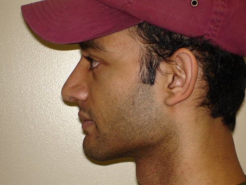 Rhinoplasty Before & After Gallery - Patient 133066228 - Image 4