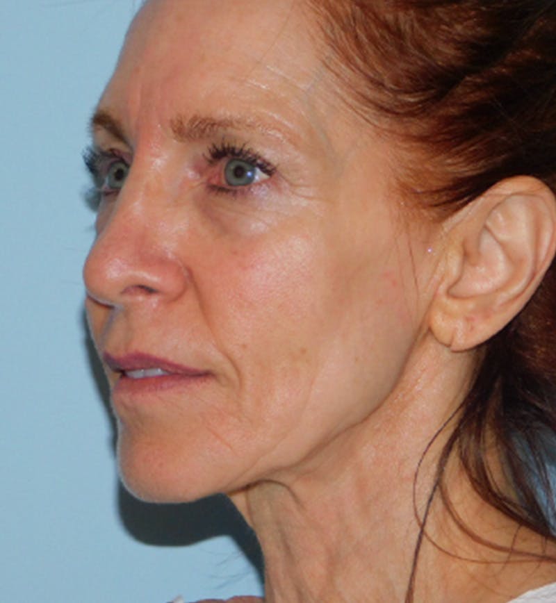 Mini-Facelift Before & After Gallery - Patient 133066231 - Image 1