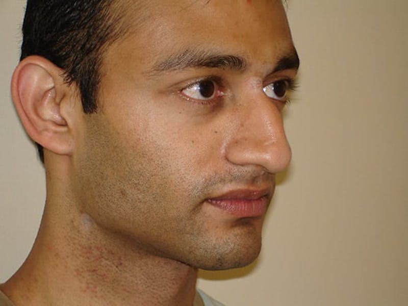 Rhinoplasty Before & After Gallery - Patient 133066228 - Image 5