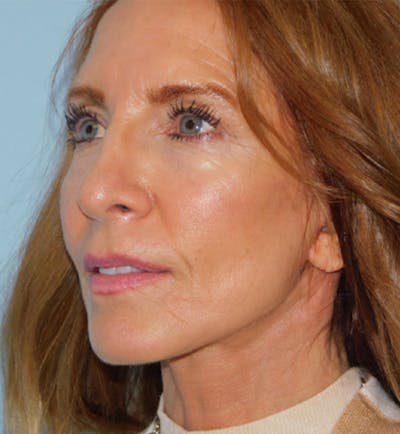 Mini-Facelift Before & After Gallery - Patient 133066231 - Image 2