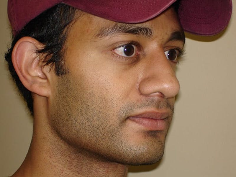 Rhinoplasty Before & After Gallery - Patient 133066228 - Image 6