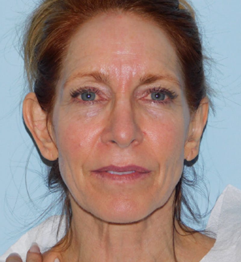 Mini-Facelift Before & After Gallery - Patient 133066231 - Image 3