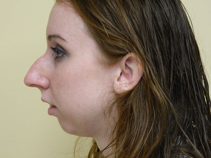 Rhinoplasty Before & After Gallery - Patient 133066236 - Image 1