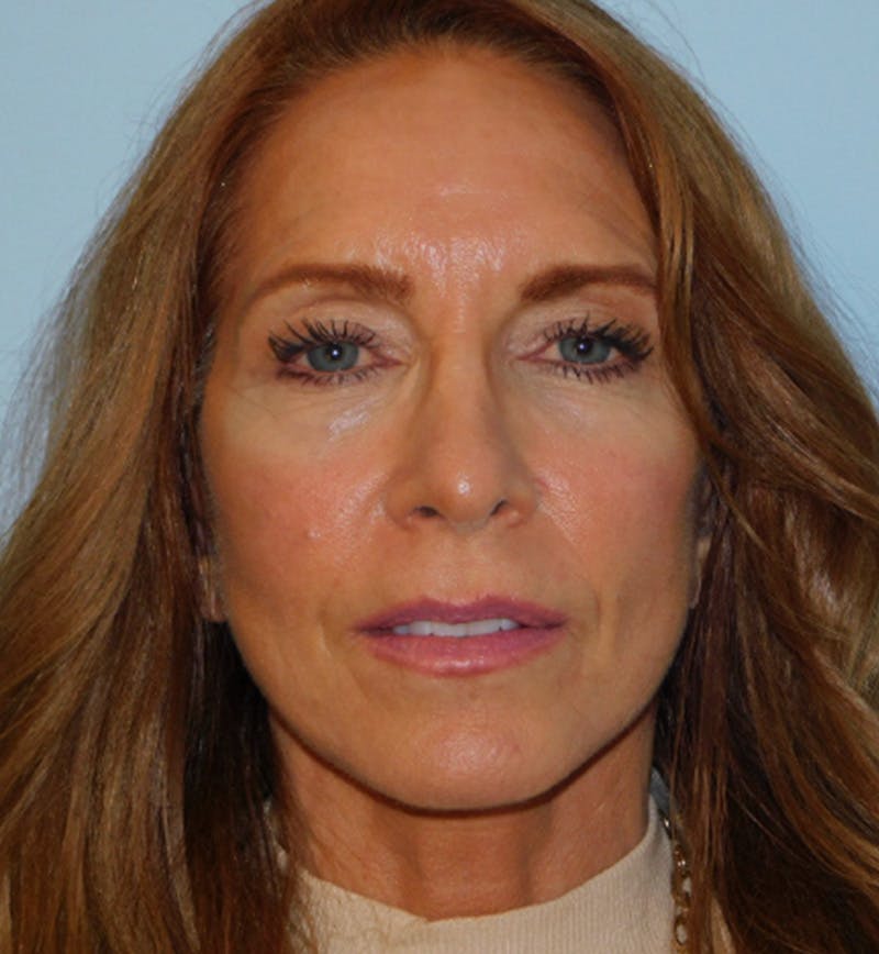 Mini-Facelift Before & After Gallery - Patient 133066231 - Image 4