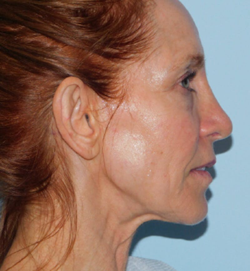Mini-Facelift Before & After Gallery - Patient 133066231 - Image 5
