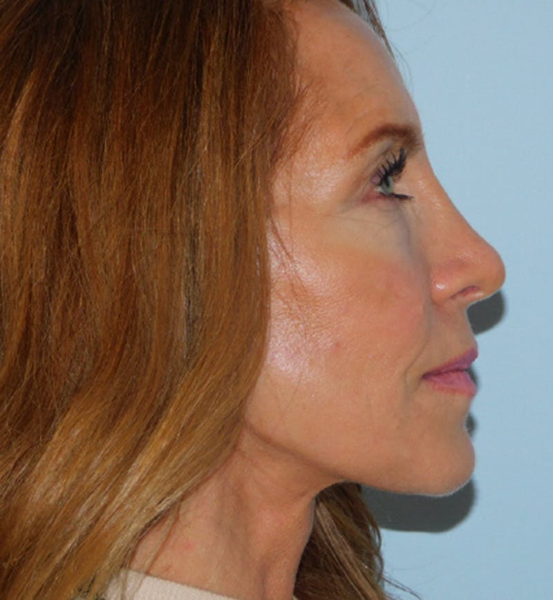 Mini-Facelift Before & After Gallery - Patient 133066231 - Image 6