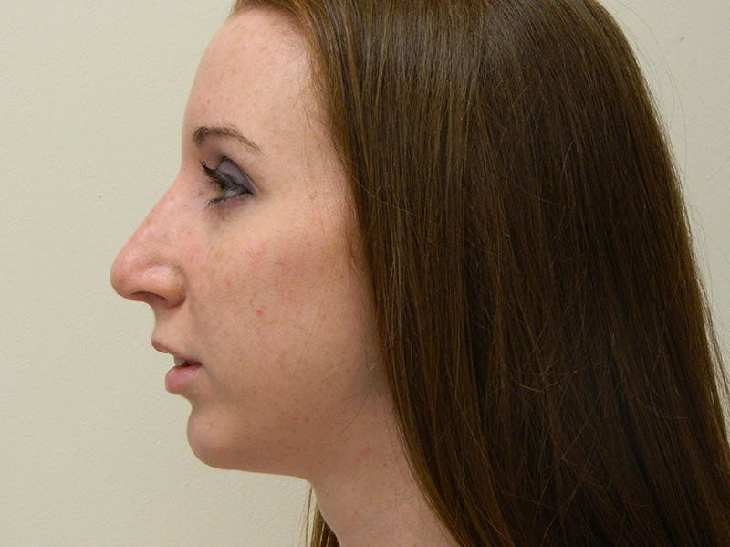 Rhinoplasty Before & After Gallery - Patient 133066236 - Image 4