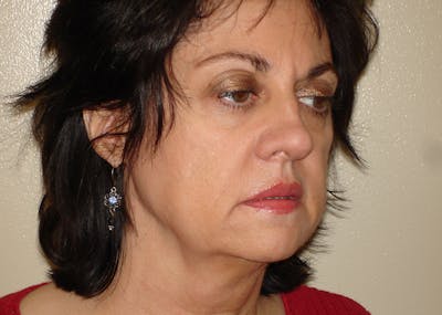 Mini-Facelift Before & After Gallery - Patient 133066237 - Image 1
