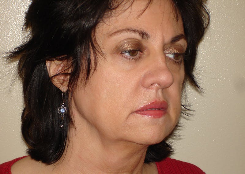 Mini-Facelift Before & After Gallery - Patient 133066237 - Image 1