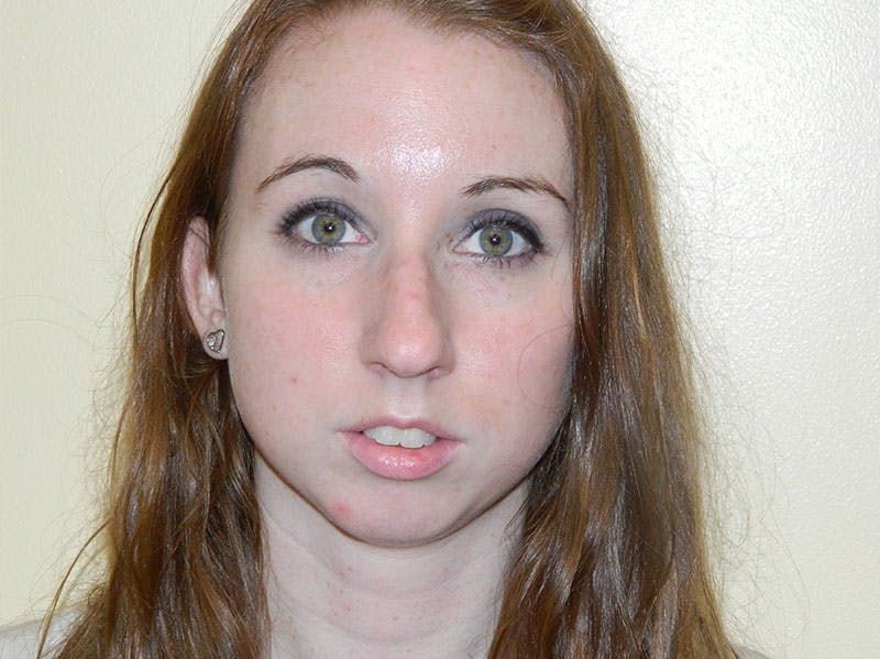 Rhinoplasty Before & After Gallery - Patient 133066236 - Image 7