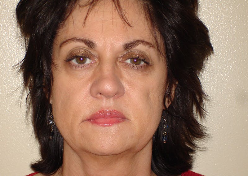 Mini-Facelift Before & After Gallery - Patient 133066237 - Image 3