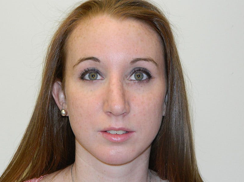 Rhinoplasty Before & After Gallery - Patient 133066236 - Image 8