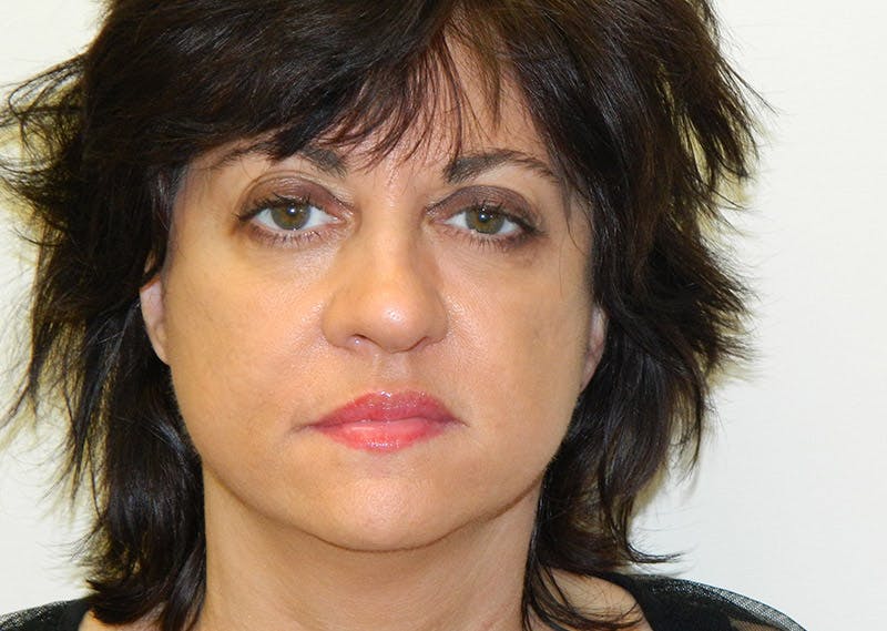 Mini-Facelift Before & After Gallery - Patient 133066237 - Image 4
