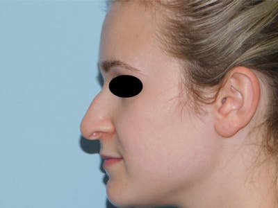 Rhinoplasty Before & After Gallery - Patient 133066244 - Image 1