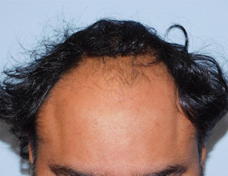 Hair Transplant (Smartgraft) Before & After Gallery - Patient 133066239 - Image 1