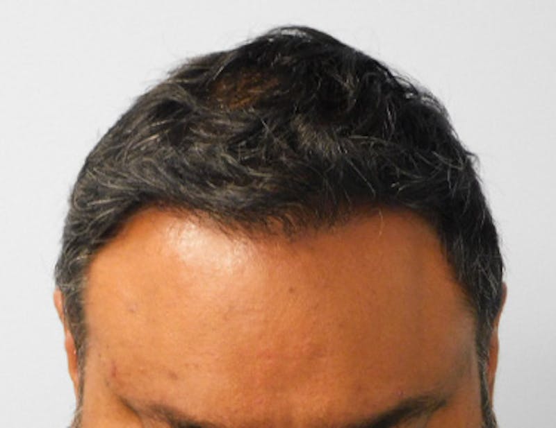 Hair Transplant (Smartgraft) Before & After Gallery - Patient 133066239 - Image 2