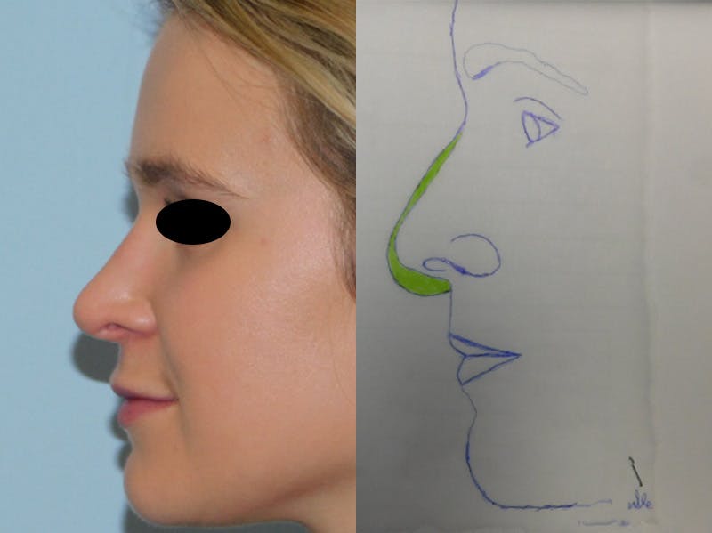 Rhinoplasty Before & After Gallery - Patient 133066244 - Image 2