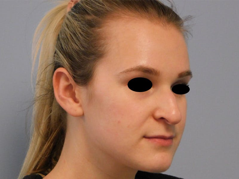 Rhinoplasty Before & After Gallery - Patient 133066244 - Image 3