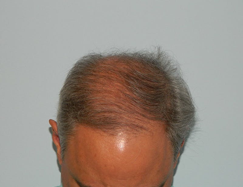 Hair Transplant (Smartgraft) Before & After Gallery - Patient 133066241 - Image 1