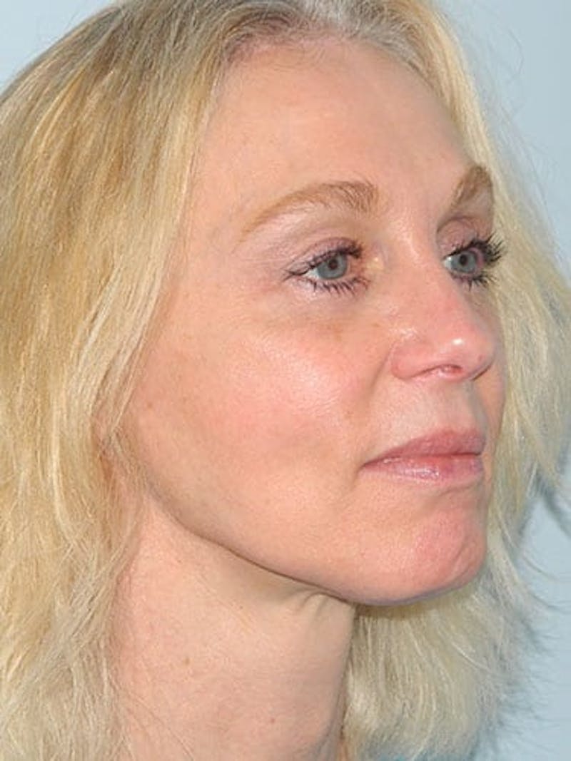 Mini-Facelift Before & After Gallery - Patient 133066240 - Image 4