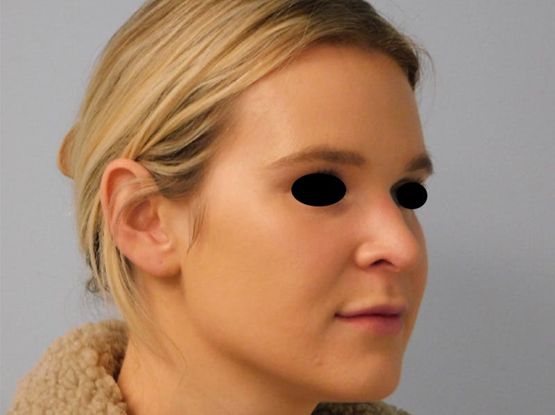 Rhinoplasty Before & After Gallery - Patient 133066244 - Image 4