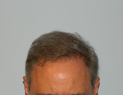 Hair Transplant (Smartgraft) Before & After Gallery - Patient 133066241 - Image 2
