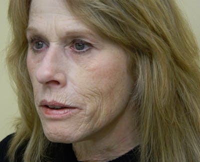 Mini-Facelift Before & After Gallery - Patient 133066247 - Image 1