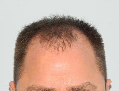 Hair Transplant (Smartgraft) Before & After Gallery - Patient 133066242 - Image 1