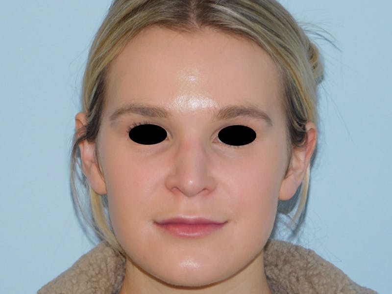 Rhinoplasty Before & After Gallery - Patient 133066244 - Image 6