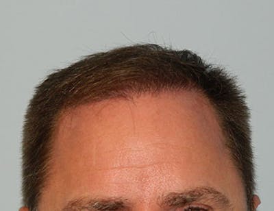 Hair Transplant (Smartgraft) Before & After Gallery - Patient 133066242 - Image 2