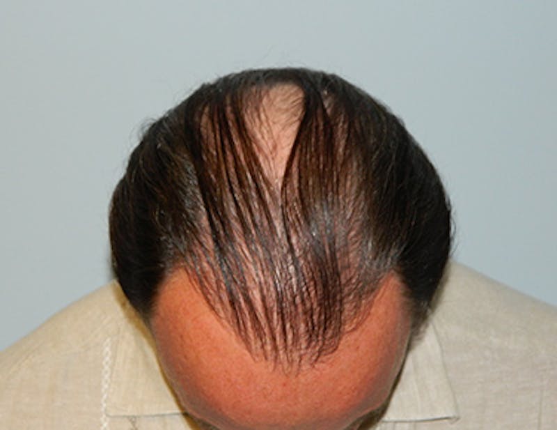 Hair Transplant (Smartgraft) Before & After Gallery - Patient 133066246 - Image 1
