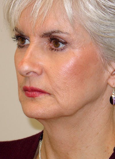Brow Lift Before & After Gallery - Patient 133066245 - Image 1