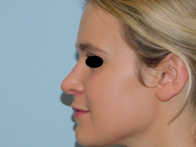 Rhinoplasty Before & After Gallery - Patient 133066244 - Image 8