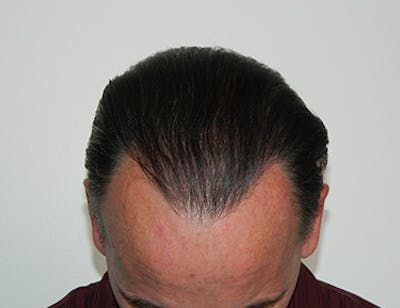Hair Transplant (Smartgraft) Before & After Gallery - Patient 133066246 - Image 2